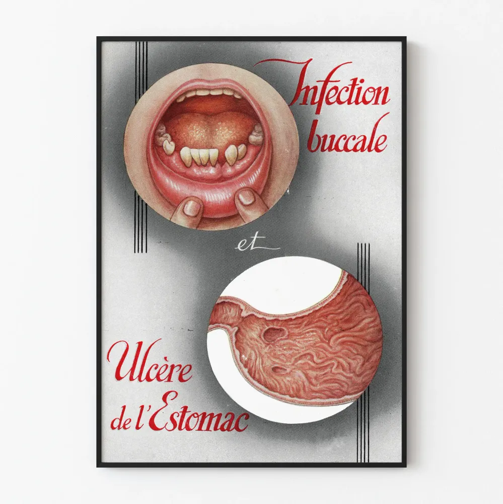 Vintagemedicaljuliste suun infektiosta ja vatsahaavasta